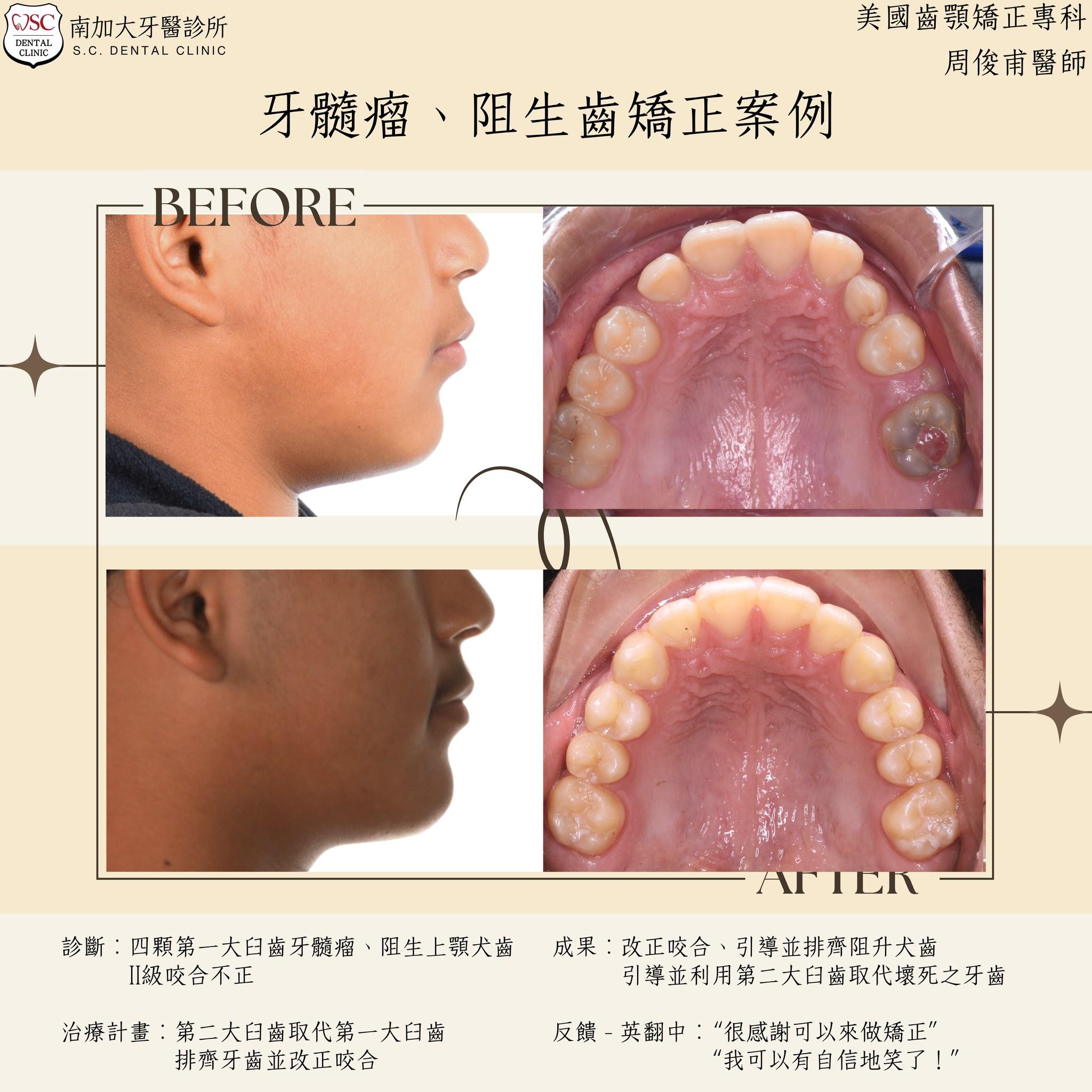 矯正案例分享|牙髓瘤、阻生犬齒、II級咬合異常矯正治療 1 499535977 122161906430513606 2621839568255290583 n