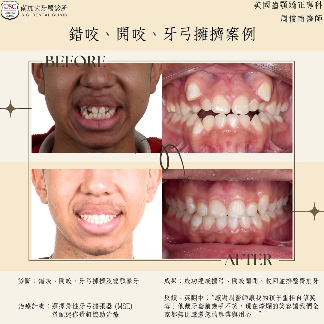 矯正案例|前牙開咬、錯咬、雙頜暴牙、牙弓擁擠 1 anterior open bite
