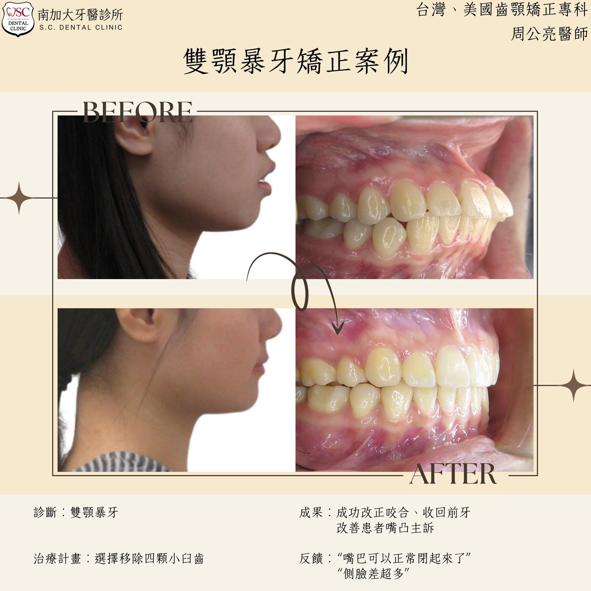 矯正案例分享|雙顎暴牙矯正 1 bimaxillary protrusion orthodontics