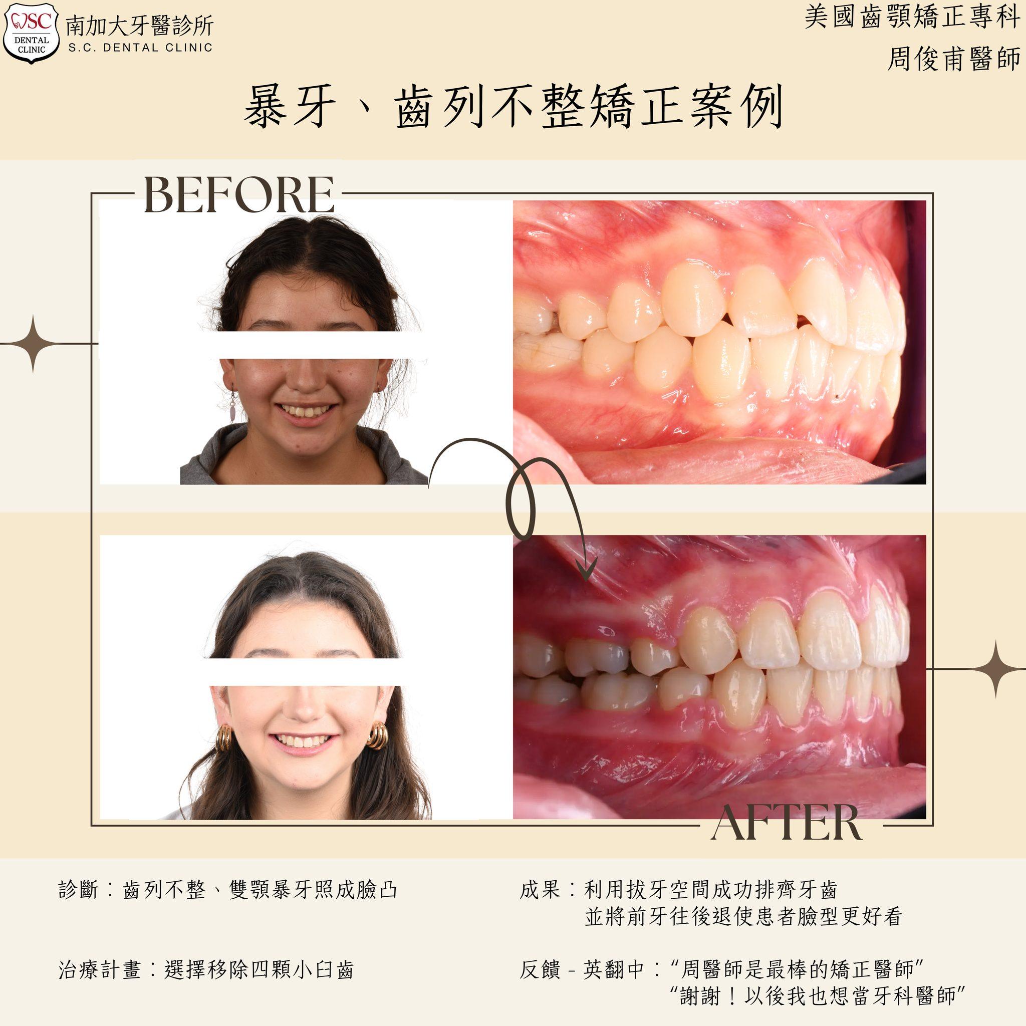 矯正案例|雙頜暴牙矯正後恢復自信笑容 1 bimaxillary protrusion