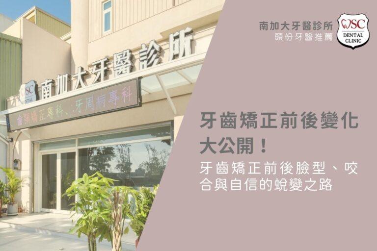 牙齒矯正前後變化大公開！牙齒矯正前後臉型、咬合與自信的蛻變之路
