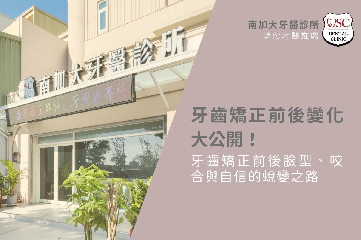 牙齒矯正前後變化大公開！牙齒矯正前後臉型、咬合與自信的蛻變之路