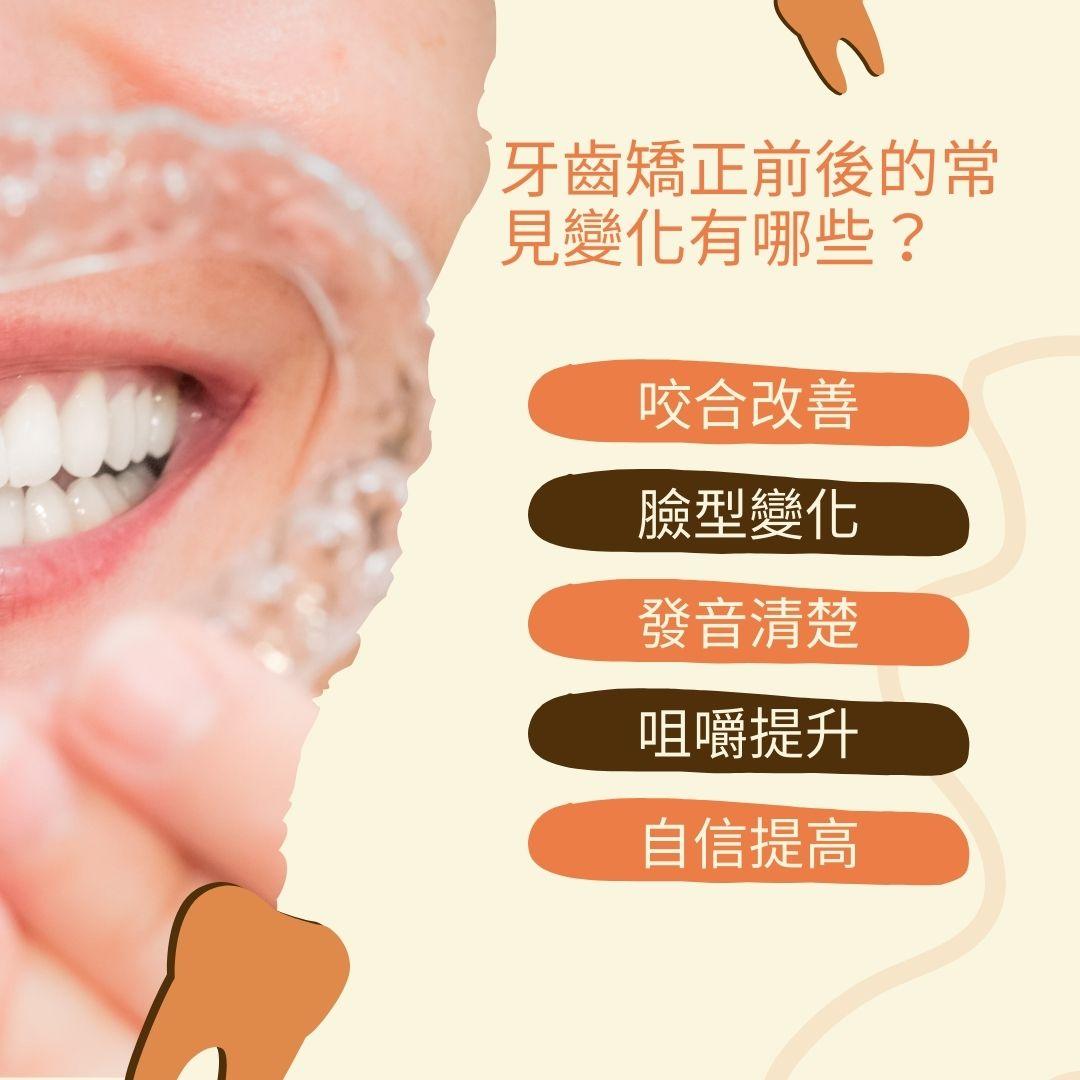 牙齒矯正前後變化大公開!牙齒矯正前後臉型、咬合與自信的蛻變之路 1 牙齒矯正前後5大變化