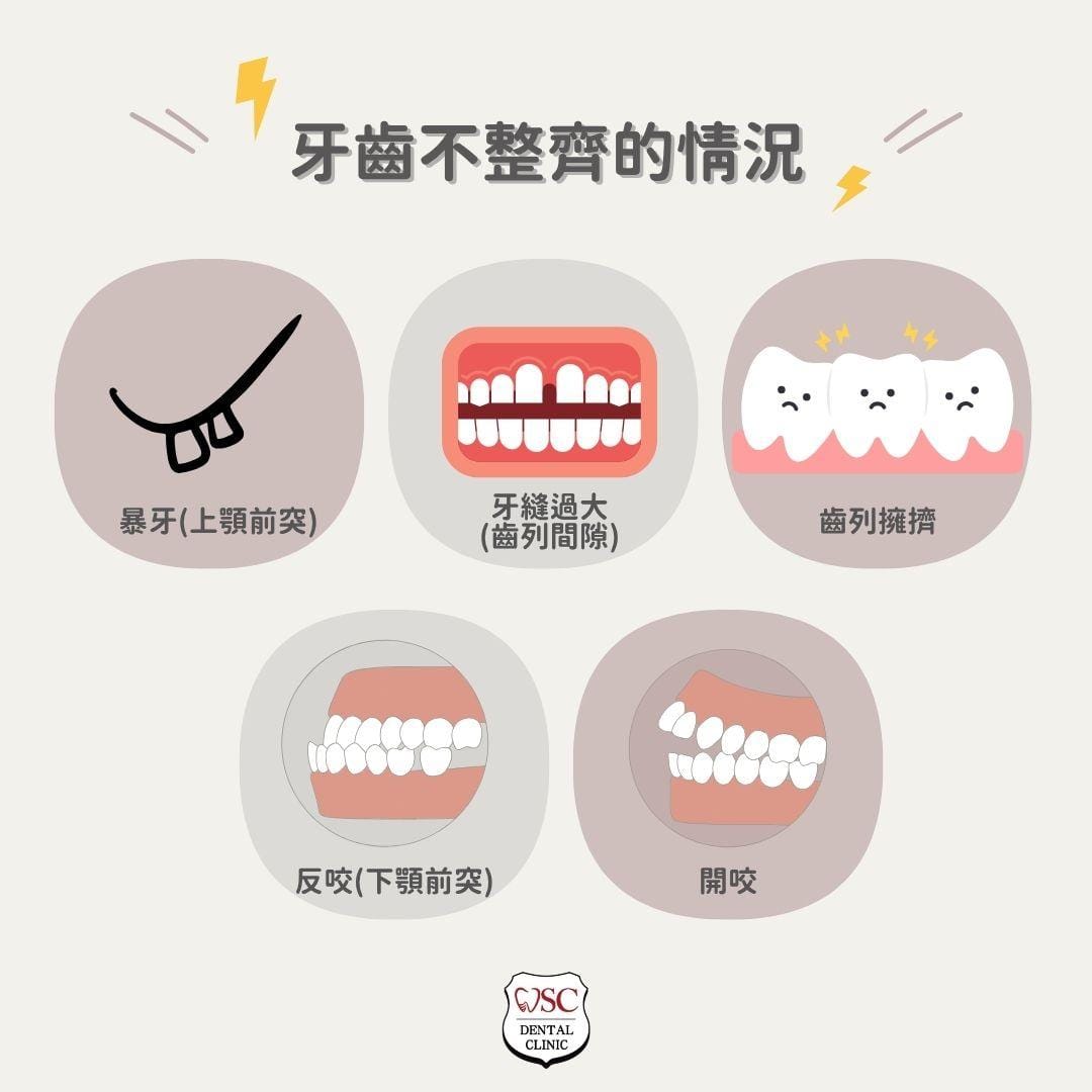 牙齒矯正器全方位指南,從種類到適用情況,找到最適合您的牙齒矯正方案 2 牙齒不整齊的情況