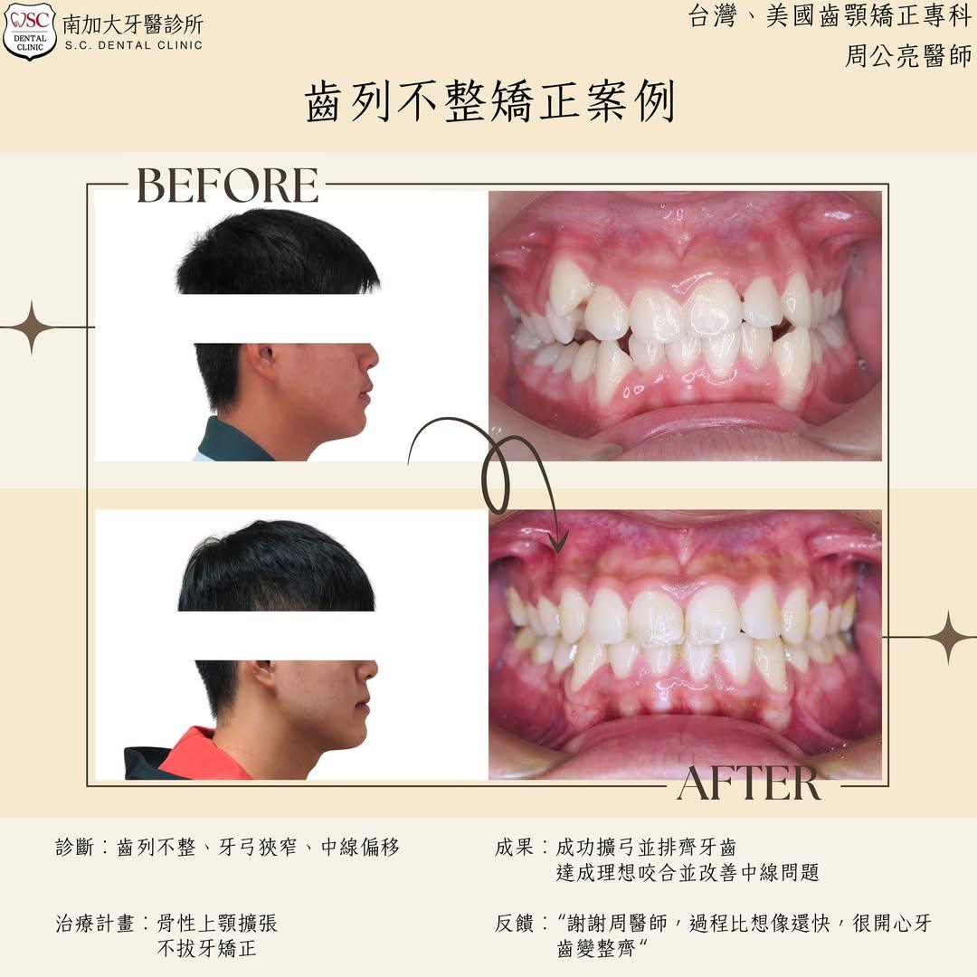 矯正案例|齒列不整 1 矯正案例 齒列不整