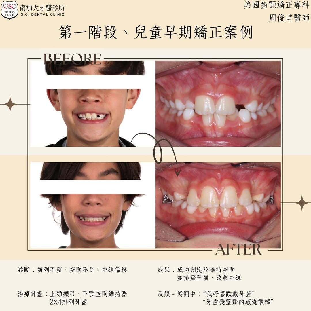 矯正案例|兒童早期矯正 1 early orthodontic treatment for children