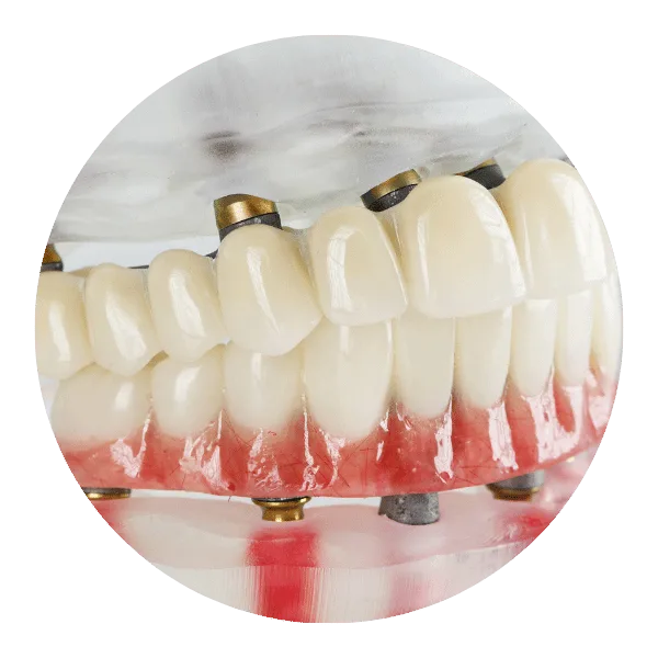 全口重建 3 full mouth reconstruction 2