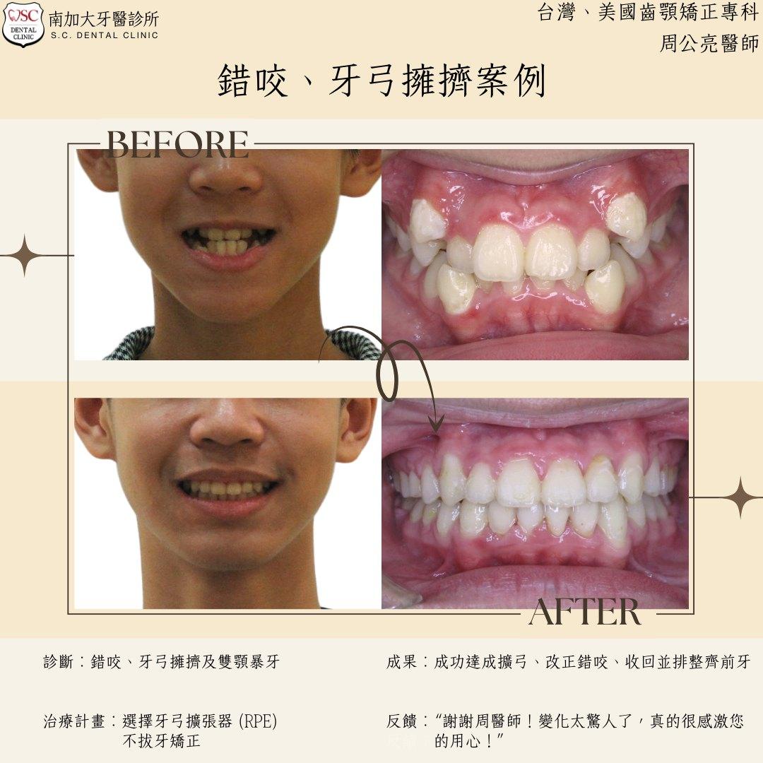 矯正案例|錯咬、牙弓擁擠 1 malocclusion and dental arch crowding