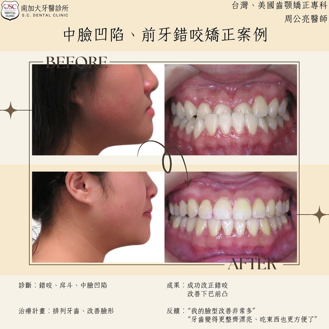 矯正案例|中臉凹陷、前牙錯咬 1 midface retrusion and anterior crossbite