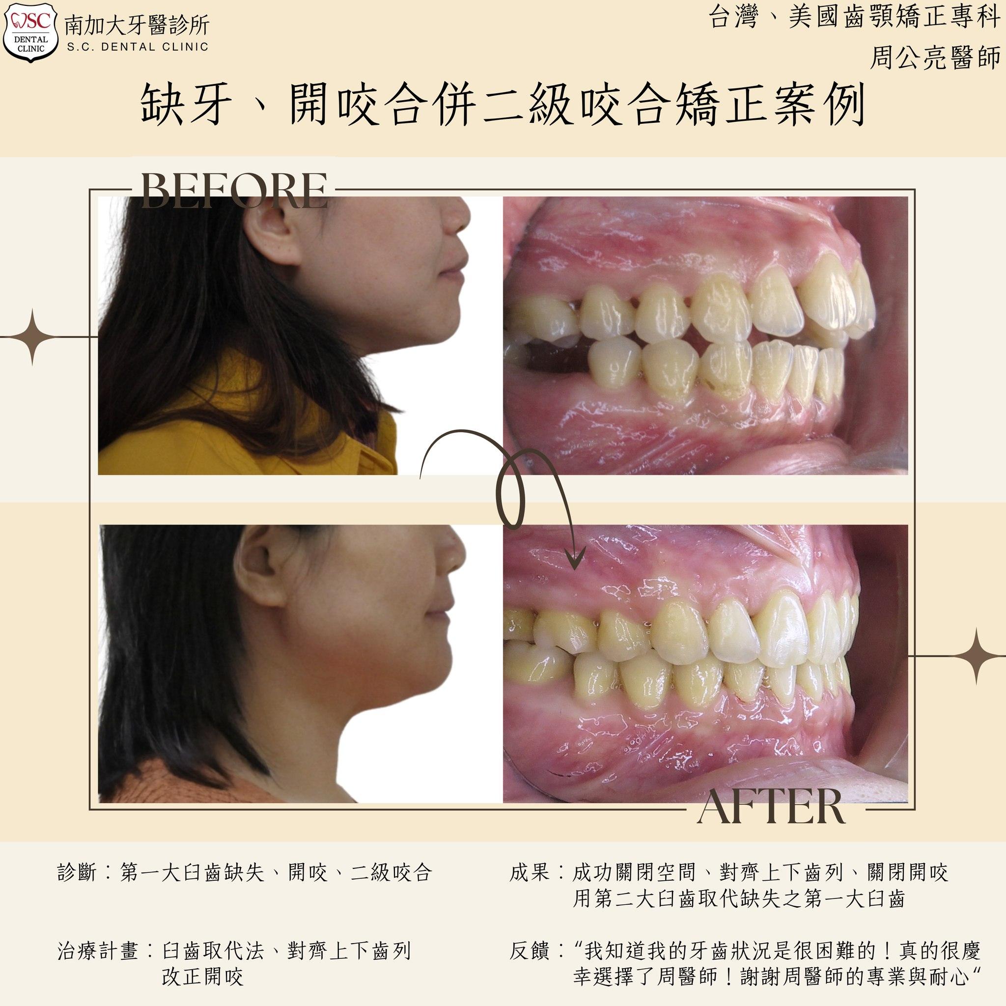 矯正案例|缺牙、開咬合併二級咬合 1 矯正案例|缺牙、開咬合併二級咬合