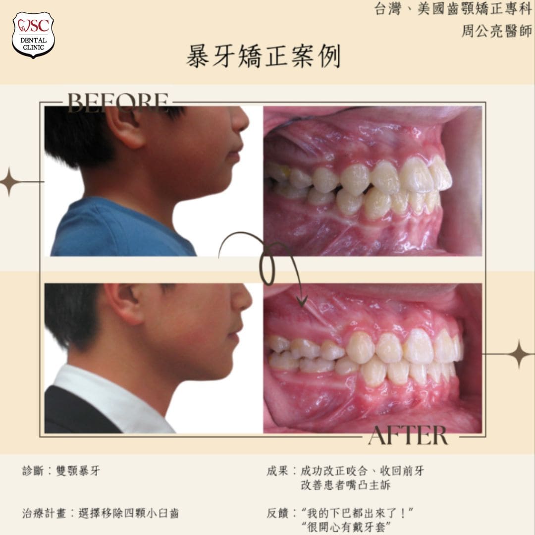 暴牙矯正案例
