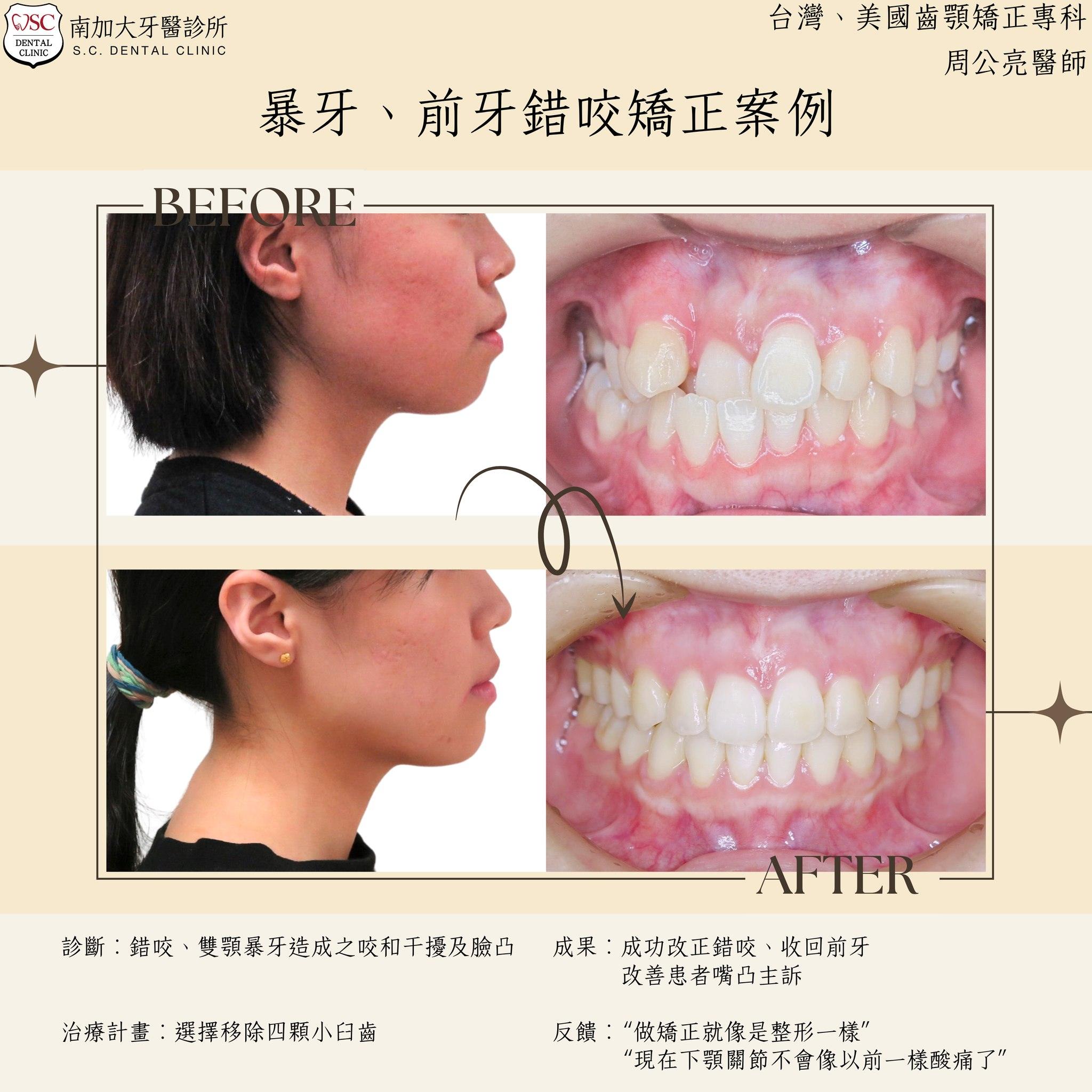 矯正案例|暴牙、前牙錯咬矯正案例 1 矯正案例 暴牙、前牙錯咬