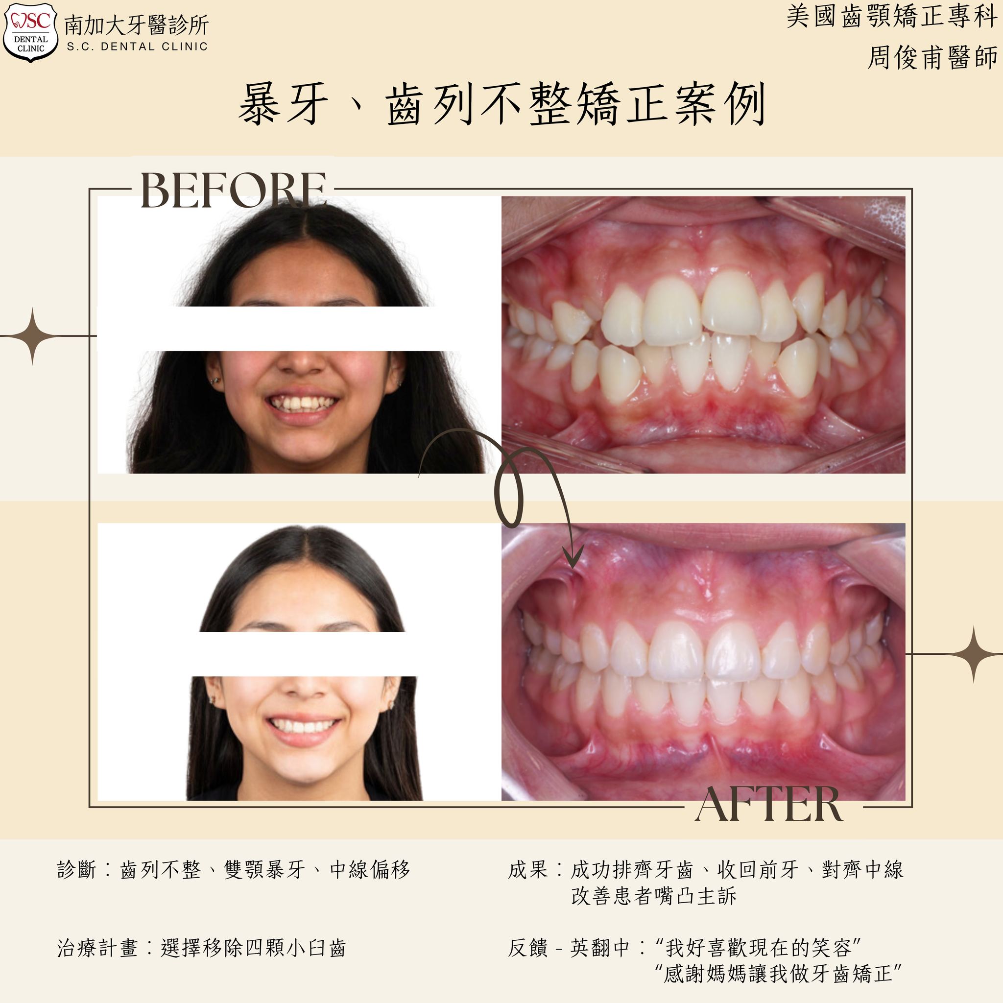 矯正案例|暴牙、齒列不整 1 protruding teeth and dental crowding 1