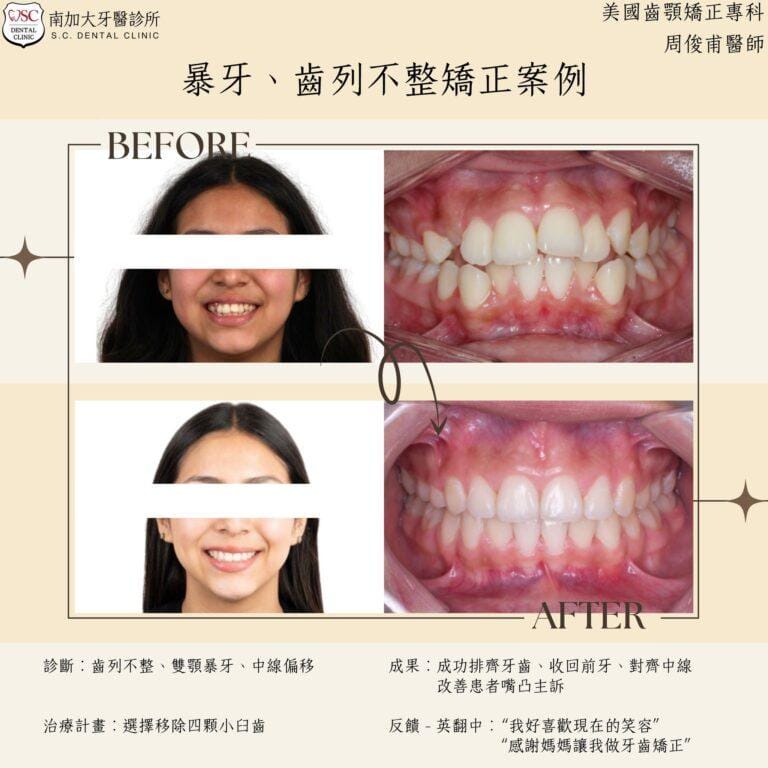 矯正案例｜暴牙、齒列不整