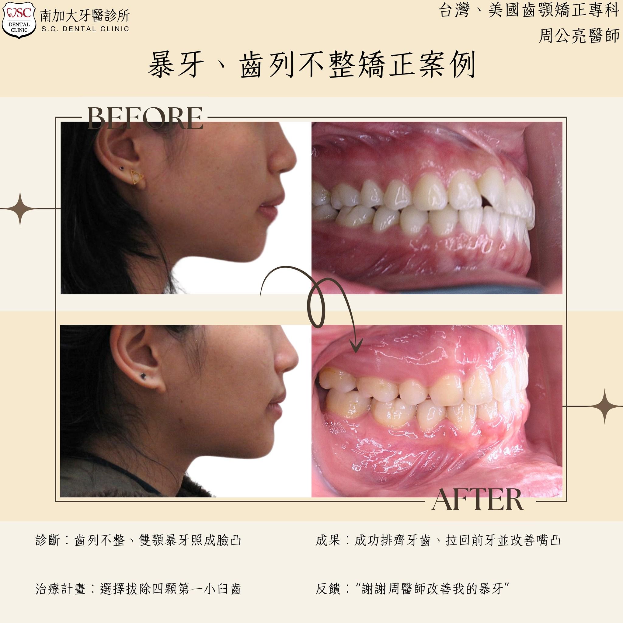矯正案例分享|暴牙矯正大變身 1 protruding teeth orthodontics