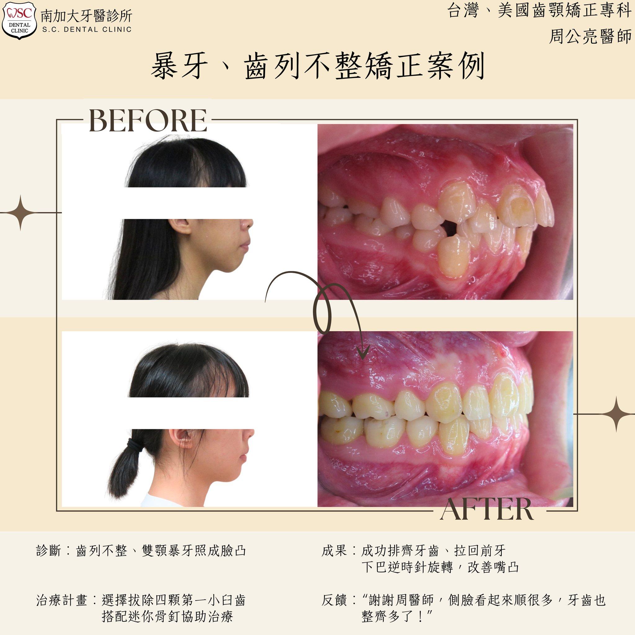矯正案例|暴牙、齒列不整 1 protruding teeth with dental crowding