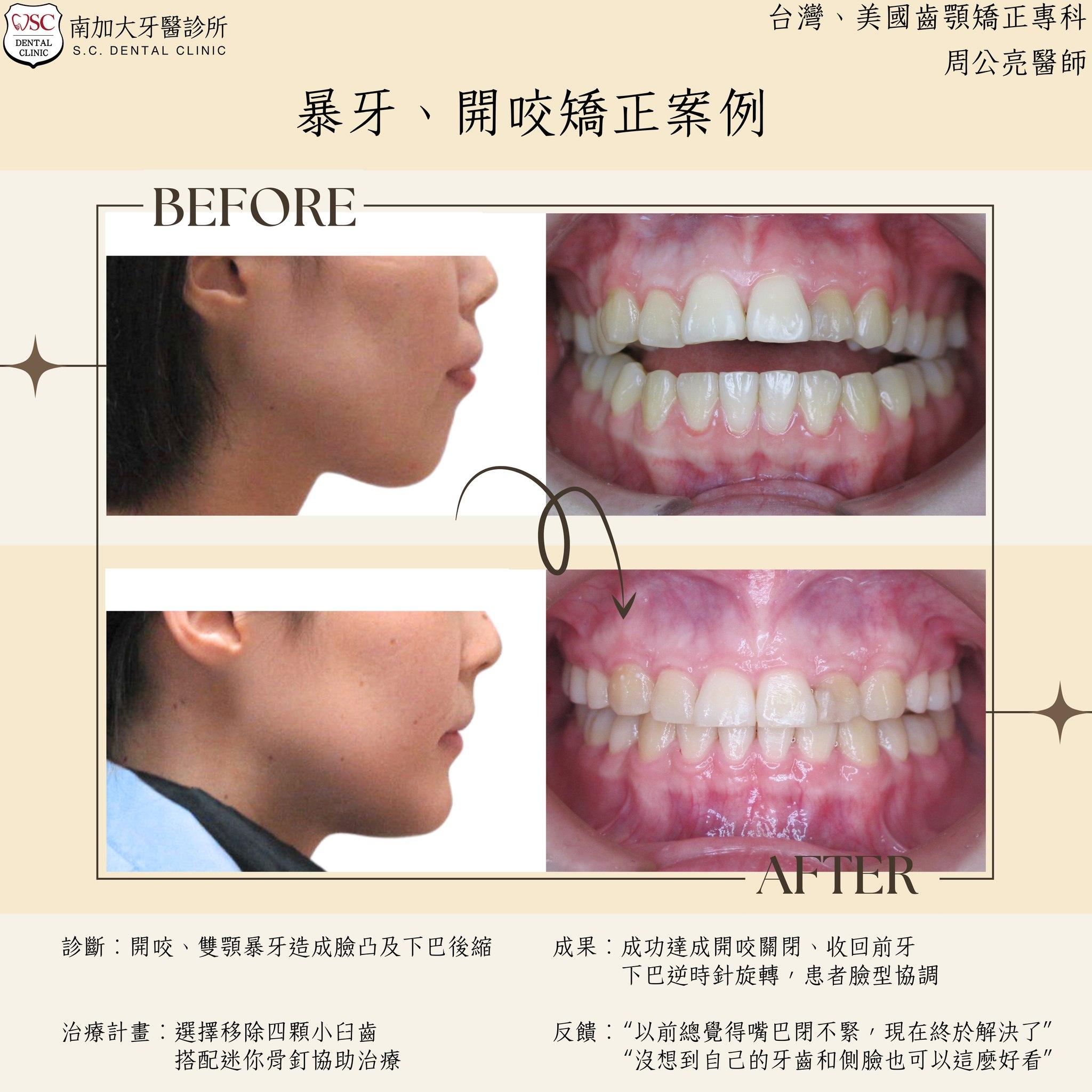 矯正案例|暴牙、開咬 1 protruding teeth with open bite