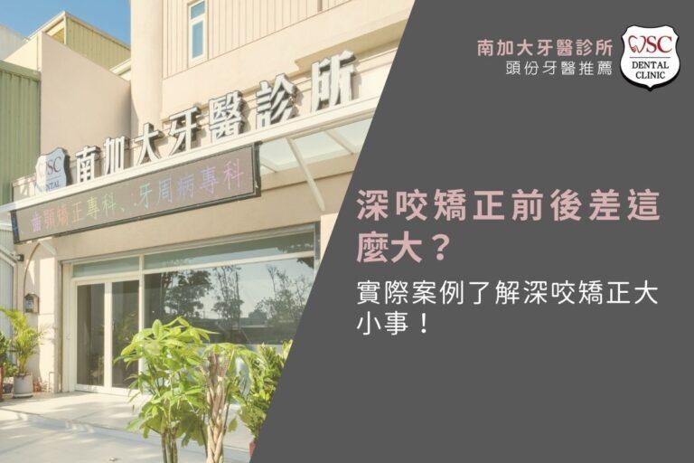 深咬矯正前後差這麼大?實際案例了解深咬矯正大小事! 2 深咬矯正前後差這麼大?實際案例了解深咬矯正大小事!