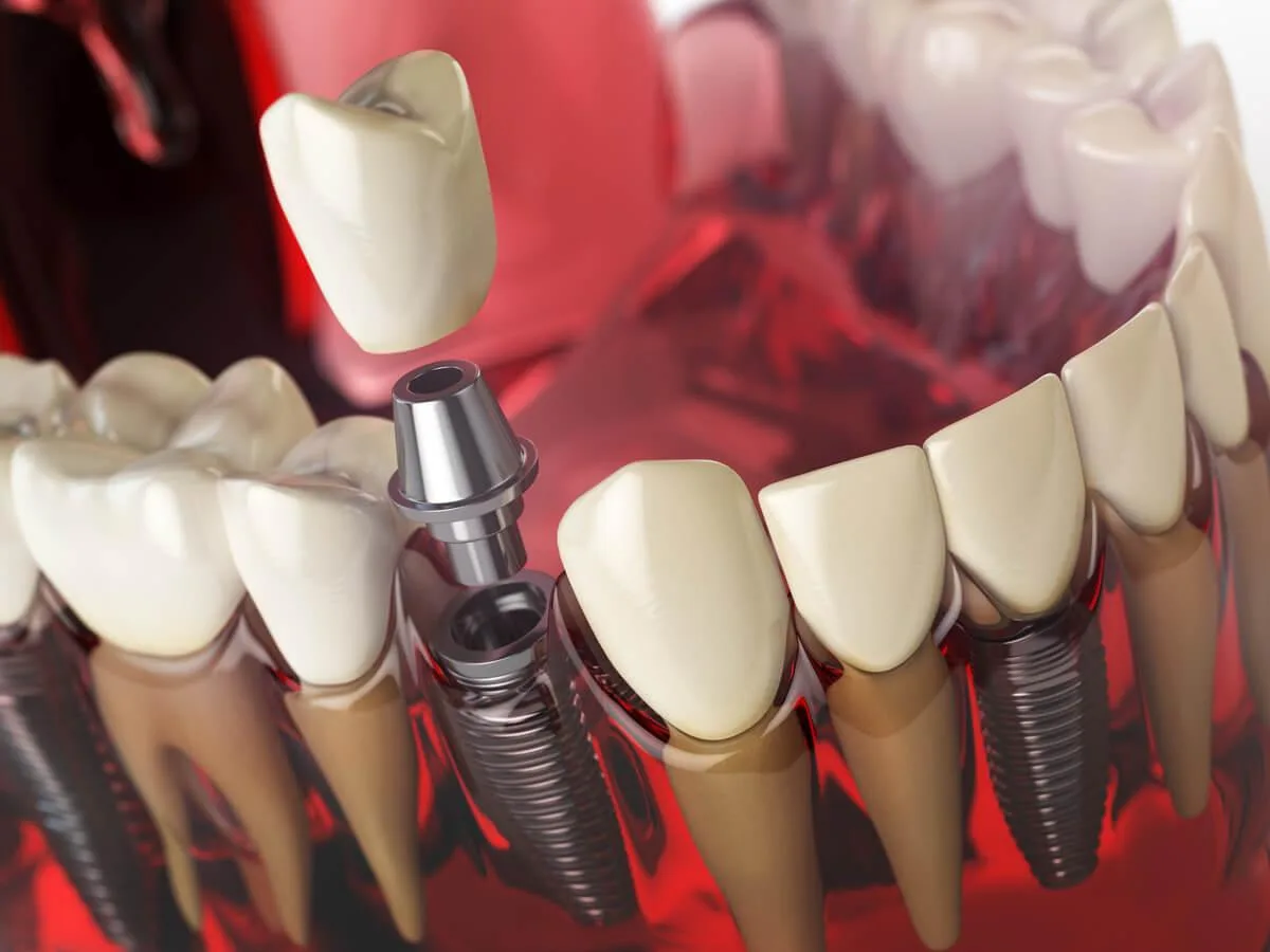 全口重建 1 tooth implant in the model human teeth gums 2