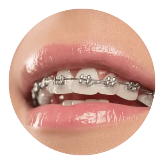 傳統矯正 2 traditional orthodontic 1