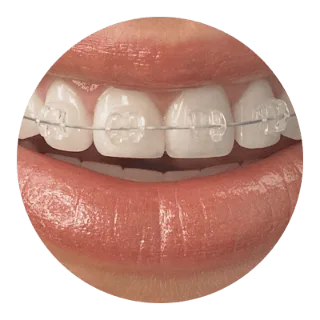 傳統矯正 3 traditional orthodontic 2