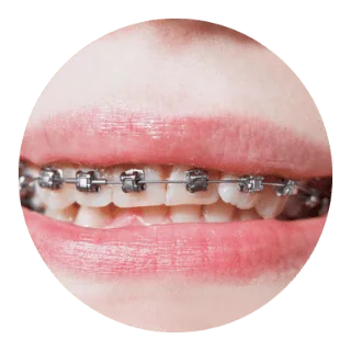 傳統矯正 4 traditional orthodontic 3